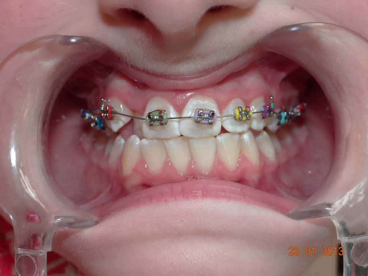 Metal braces