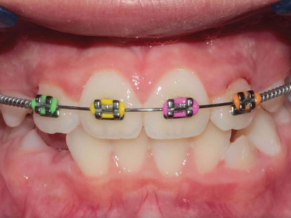 Early orthodontic treatment in a child