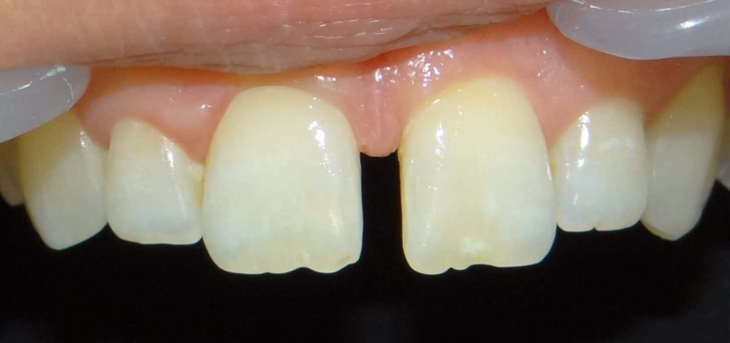 Bonding — before treatment — case 1