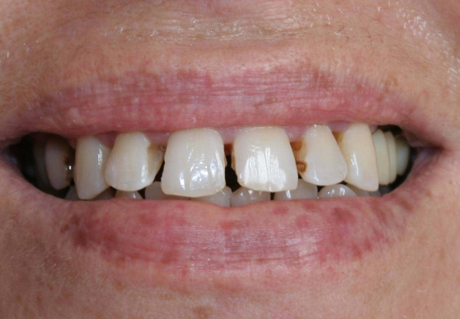 Bonding — before treatment — case 2