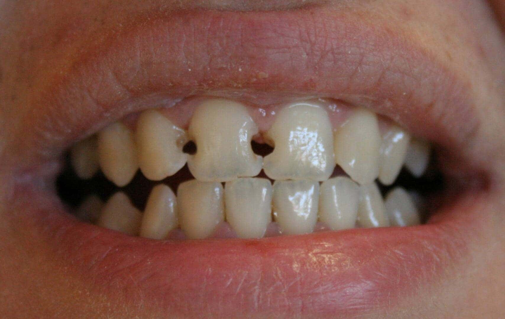 Bonding — before treatment — case 3