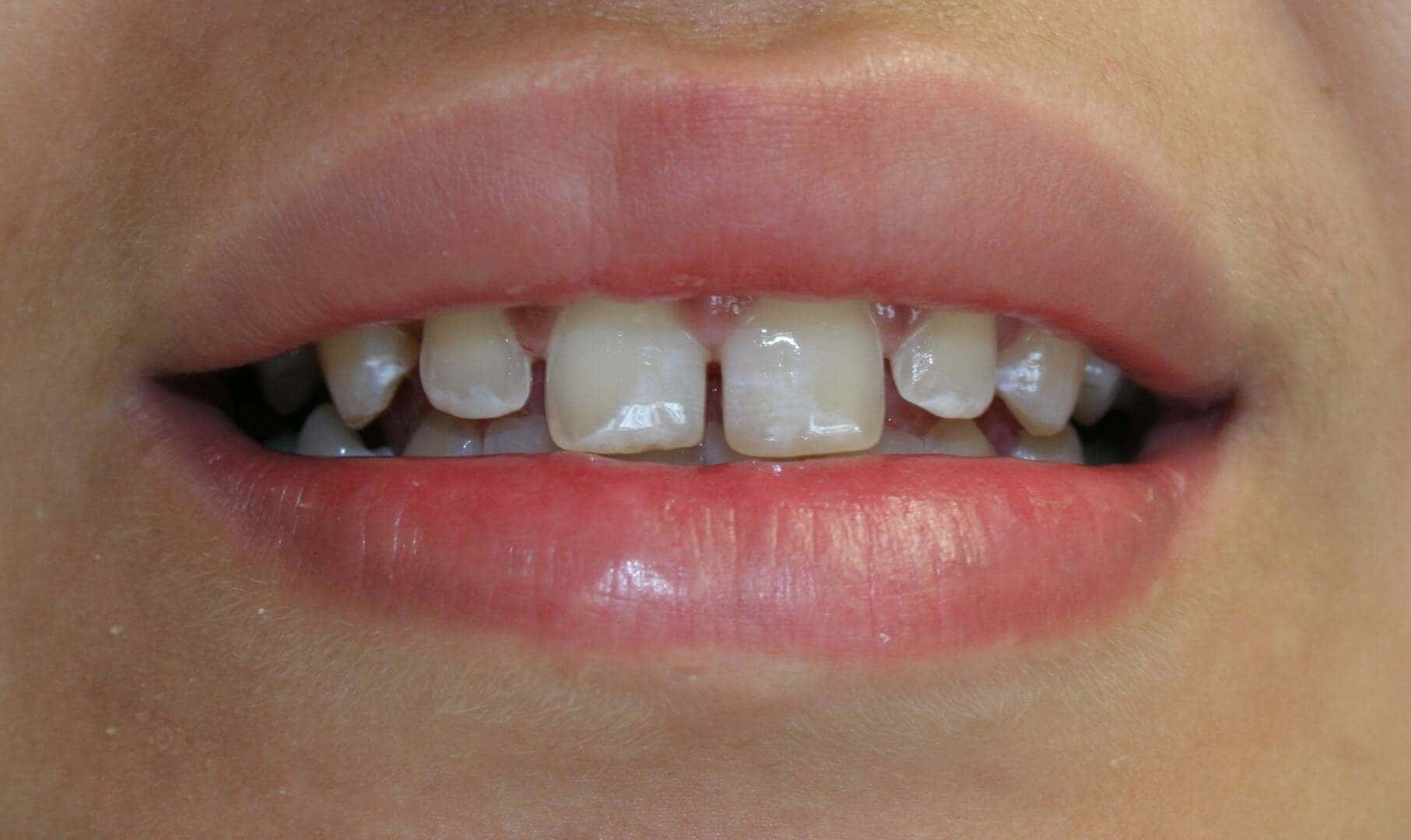 Veneers — before treatment — case 1