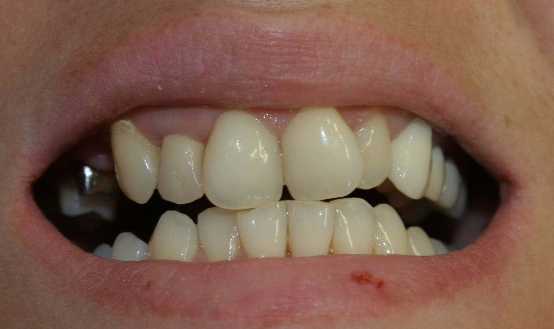 Veneers — before treatment — case 2