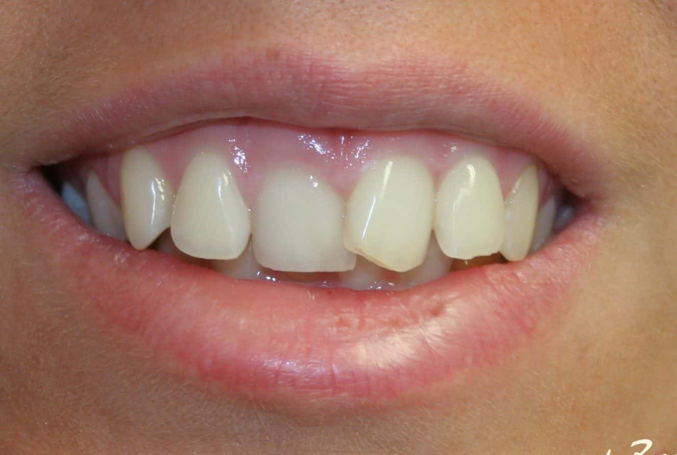 Veneers — before treatment — case 3