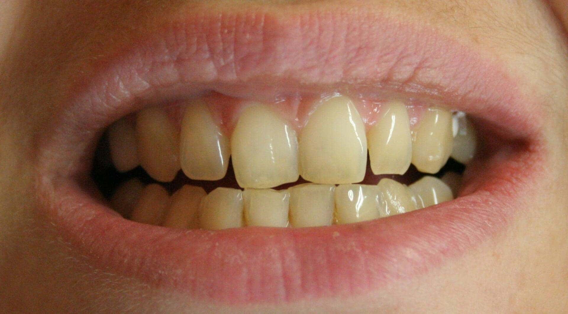 Whitening — before treatment — case 1