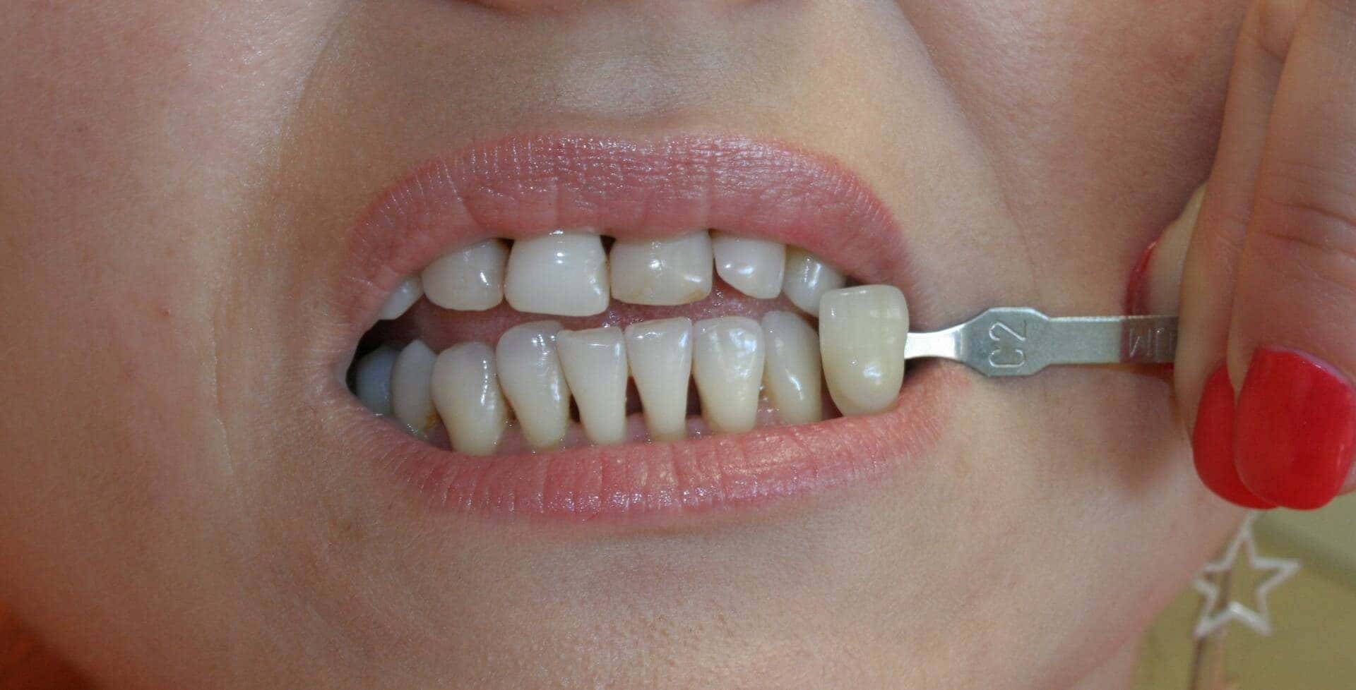 Whitening — before treatment — case 2