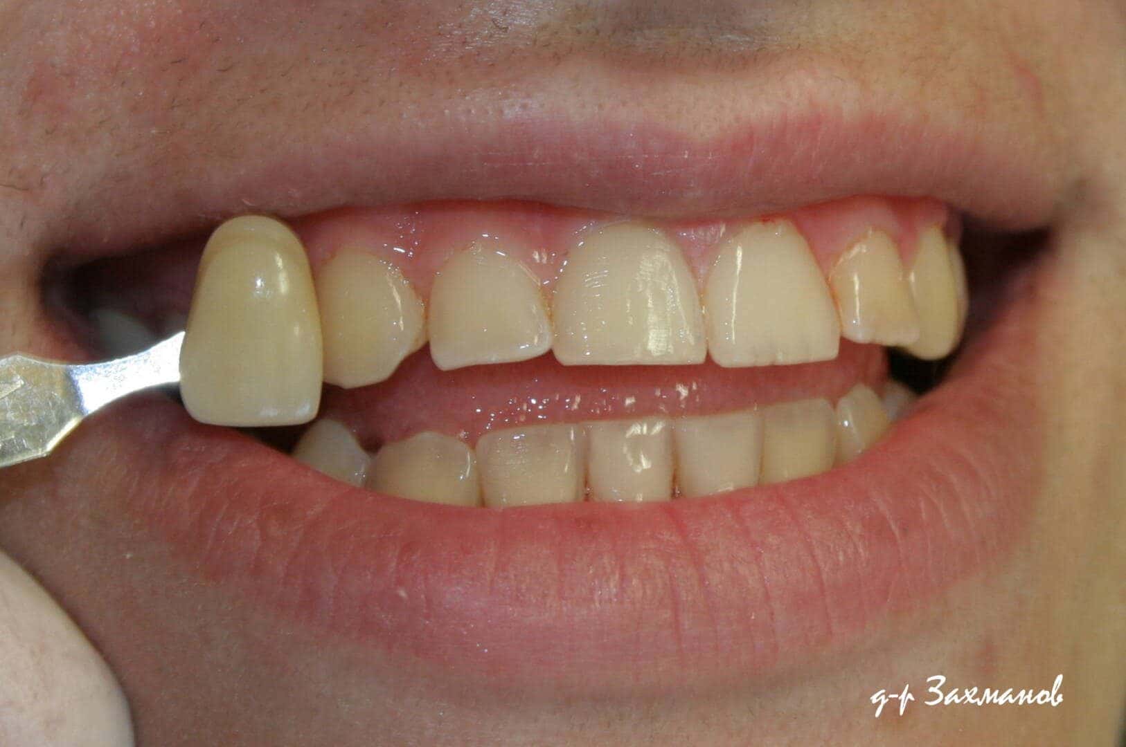 Whitening — before treatment — case 3