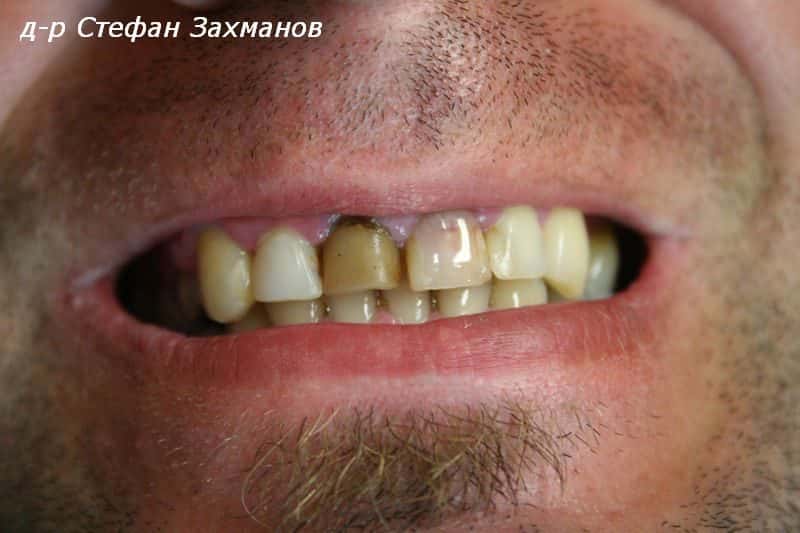 Prosthetics — before treatment — case 1