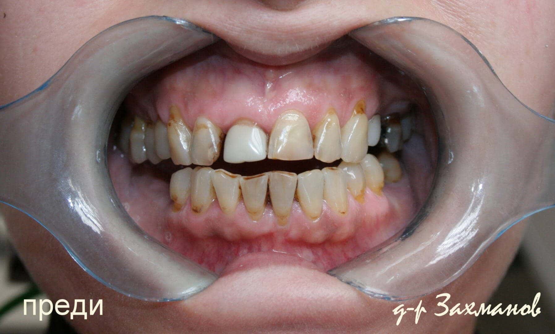 Prosthetics — before treatment — case 2