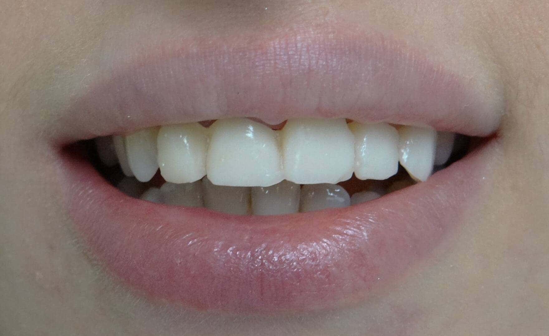 Prosthetics — before treatment — case 3